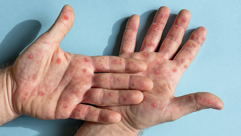 Sobe para 140 número de casos confirmados de Mpox no país, em 2026