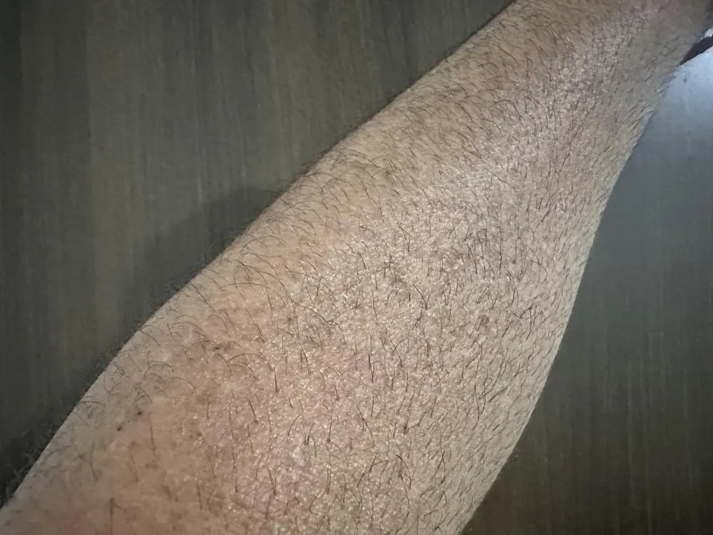 Casos de câncer de pele saltam de 4 mil para mais de 72 mil em 10 anos