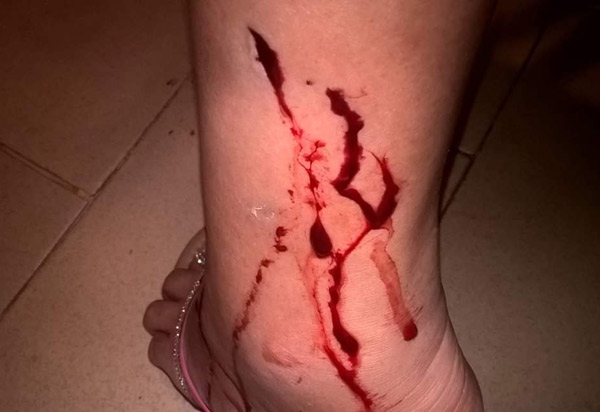 Brumado: mulher é atacada por cachorros no centro da cidade e cobra medidas do poder público