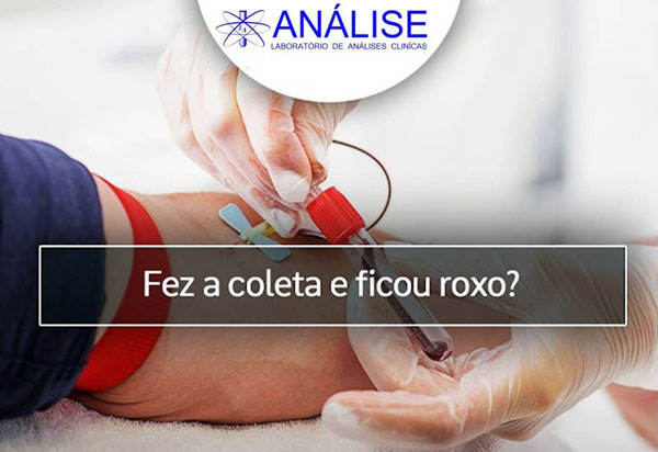 Informativo Laboratório Análise: Após a coleta de sangue para exame, é normal o local ficar roxo?
