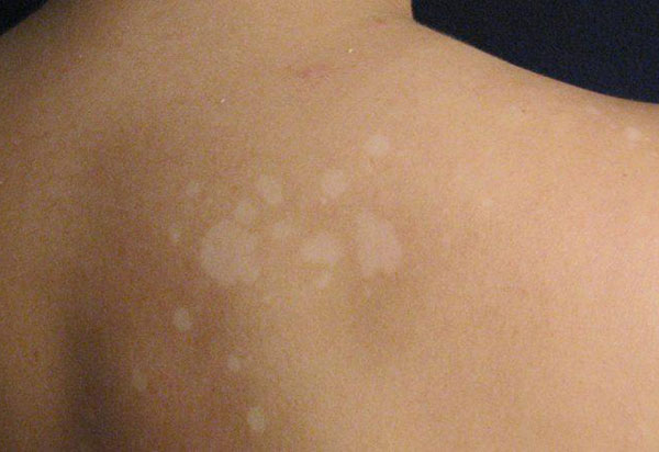 Bolsonaro quer intensificar combate à hanseníase no país