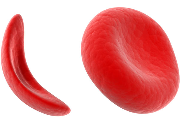 Dia 19 de junho é comemorado o Dia Mundial de Conscientização sobre a Doença Falciforme