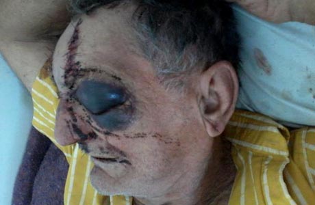 Idoso de 74 anos leva 40 pontos no rosto após espancamento