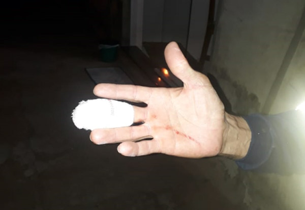 Brumado: Gari tem dedo cortado por material perfurocortante durante coleta de lixo