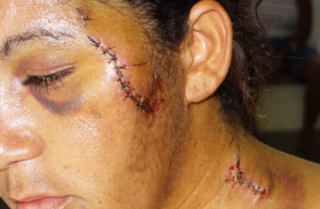 NO ROSTO: MULHER É ESFAQUEADA EM BARRA DA ESTIVA