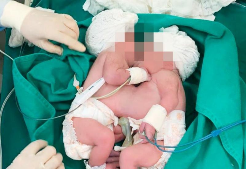 Soteropolitana dá a luz a gêmeas siamesas nesta quinta-feira (29)