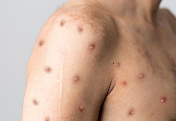 MP cria grupo de trabalho para acompanhar enfrentamento da varíola dos macacos na Bahia