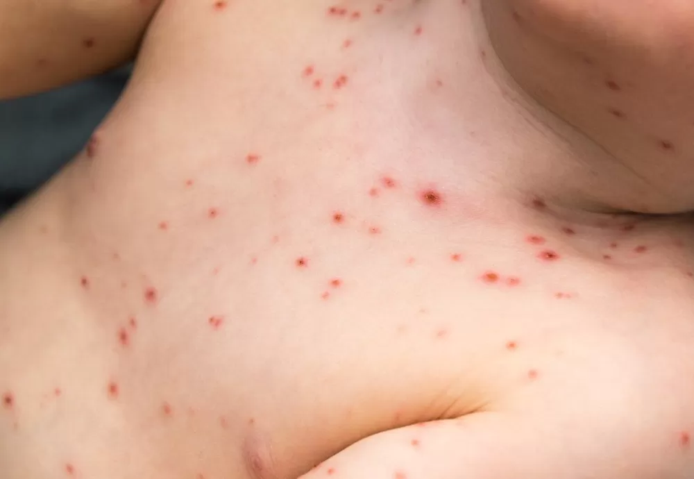 Surto de Catapora na Bahia: Sesab emite alerta e medidas de prevenção são reforçadas