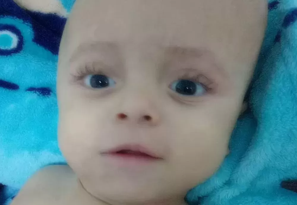 Triste notícia: criança diagnosticada com hidrocefalia morre aos 2 anos em hospital de Brumado