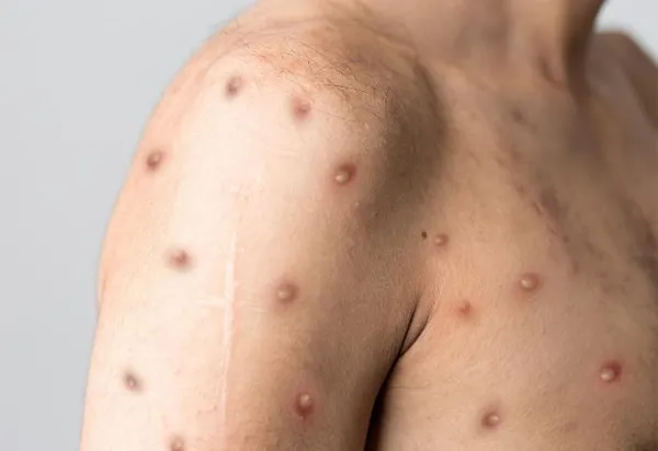 Brasil supera marca de mil casos de mpox em 2024