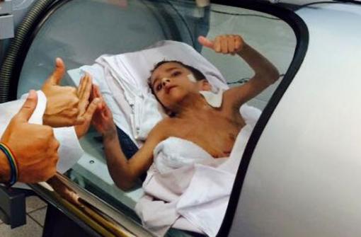 Gêmeo siamês sobrevivente tem piora no estado de saúde