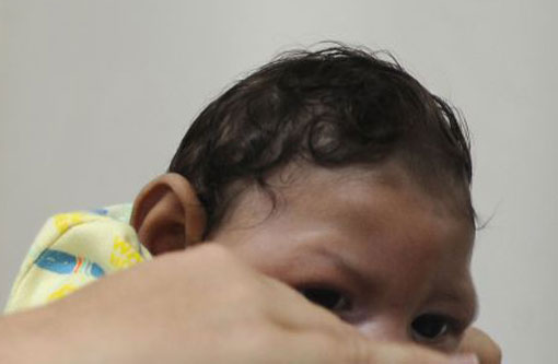 Bahia tem aumento nos casos de Microcefalia