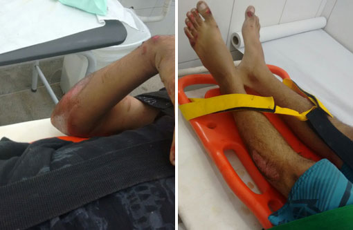 Brumado: motociclista cai e se fere após passar sobre lombofaixa; a elevação não possui sinalização