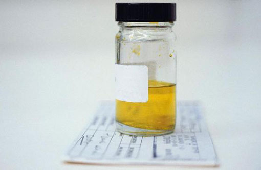 Barato e preciso: Novo teste de câncer de próstata com urina pode aposentar toque retal