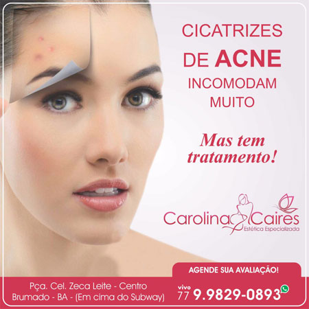 Carolina Caires - Estética Especializada: conheça os melhores tratamentos para a Acne