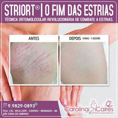 Carolina Caires - Estética Especializada: conheça o Striort e dê adeus as estrias