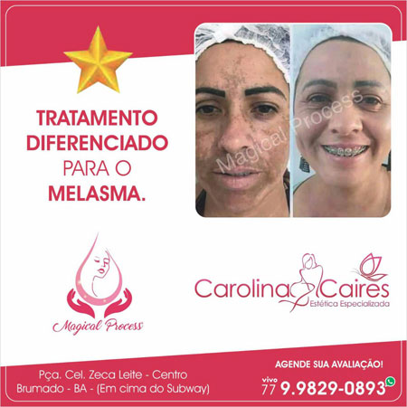 Processo Mágico de Tratamento do Melasma, agora na Carolina Caires Estética Especializada 