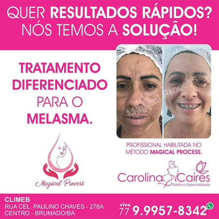 Processo Mágico de Tratamento do Melasma, agora na Carolina Caires Estética Especializada