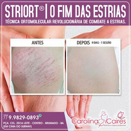 Carolina Caires - Estética Especializada conheça o Striort e dê adeus as estrias
