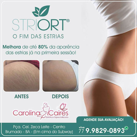 Carolina Caires - Estética Especializada:  conheça o Striort e dê adeus as estrias