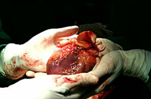 Bahia registra três doações de órgãos no mesmo dia