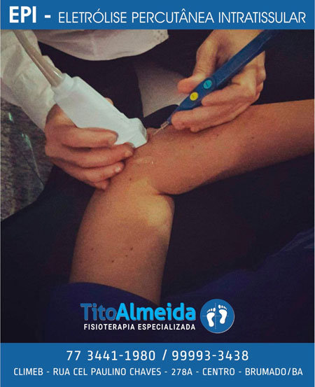 Tito Almeida - Fisioterapia Especializada: conheça a Eletrólise Percutânea Intratissular