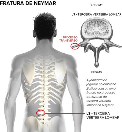 Neymar recorre a especialistas para tentar jogar a final