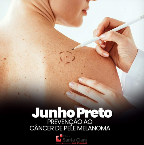 Clínica Santa Clara: Saiba mais sobre o câncer de pele melanoma