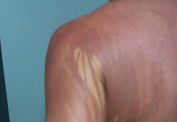 Turista fica com manchas no corpo após banho de mar em Ilhéus