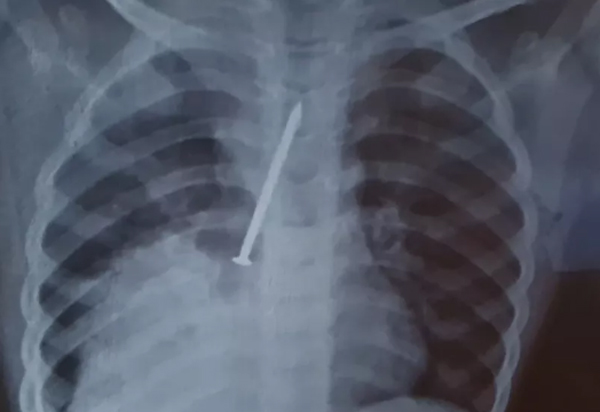 Menino morre com prego no pulmão e Polícia Civil investiga se houve negligência médica