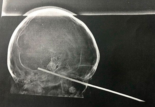 Bahia: menino de 8 anos tem espeto cravado no olho durante brincadeira com amigo