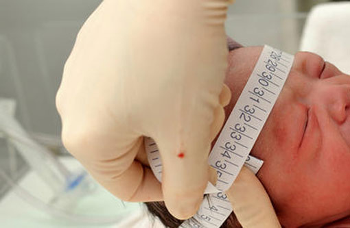  Microcefalia: grupo defende direito ao aborto; CNBB é contra