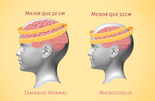 Bahia: sobe para 775 número de casos de microcefalia