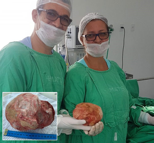 Durante cirurgia, médicos retiram pedra de 1,3 Kg e 18 cm da bexiga de lavrador
