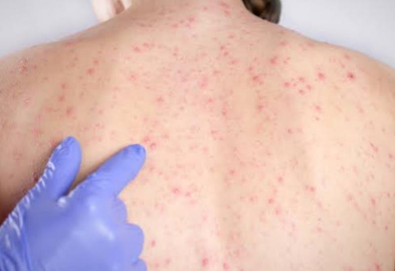 Municípios da microrregião de Brumado (BA) registram aumento de 222% nos casos de sífilis