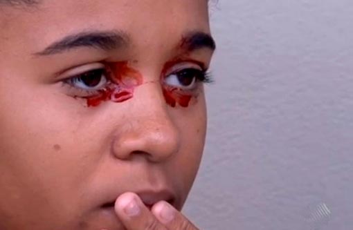 Adolescente sofre com sangramentos pelos olhos no sul da Bahia