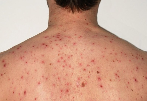 Bahia confirma dois casos de sarampo