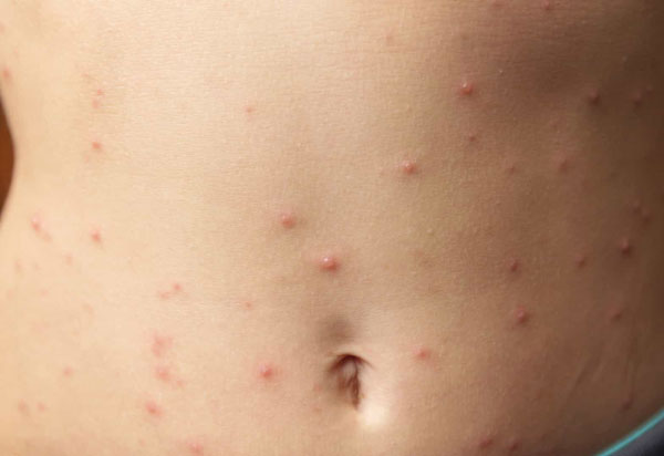 Sesab faz alerta para a prevenção do sarampo