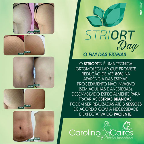 Carolina Caires Estética Especializada: livre-se do efeito 'zebrinha' das estrias 