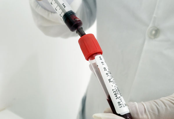 Covid-19: Brumado detecta amostra da variante Delta