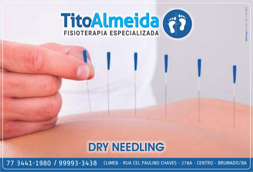 Tito Almeida - Fisioterapia Especializada: conheça o Dry Needling