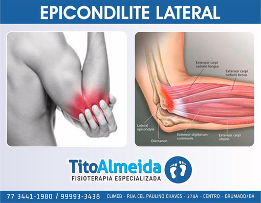 Tito Almeida Fisioterapia: Epicondilite Lateral - entenda a dor crônica de cotovelo