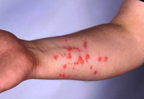 Bahia confirma mais dois casos de varíola dos macados