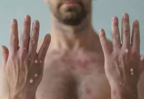 Varíola dos macacos: OMS declara emergência internacional de saúde